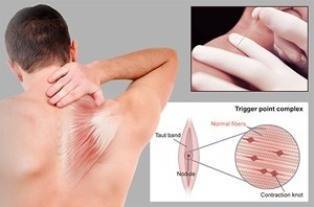 will dry needling help lower back pain