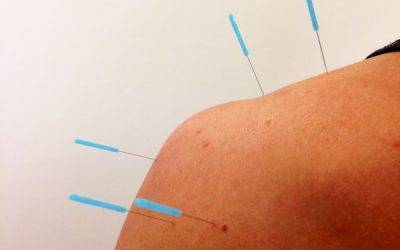 how is dry needling different from acupuncture