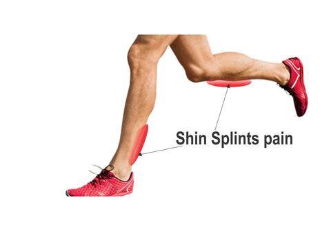 will dry needling help shin splints