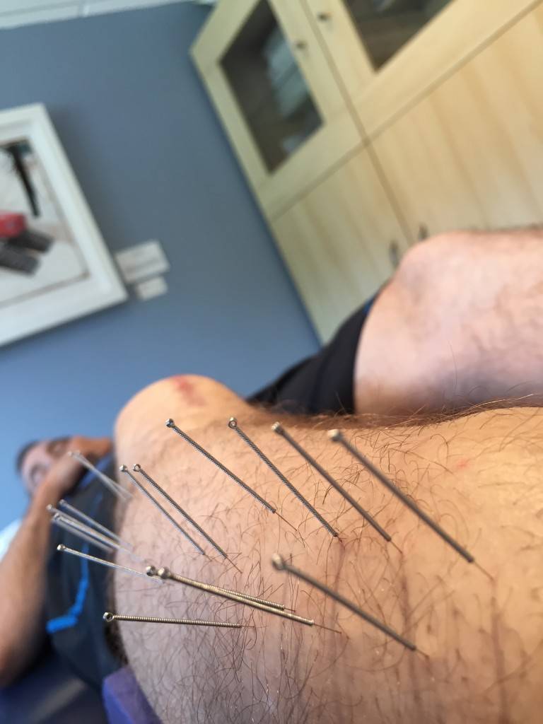 what is dry needling in physical therapy