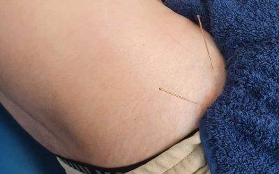 can dry needling help sciatica