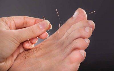 how does dry needling help plantar fasciitis