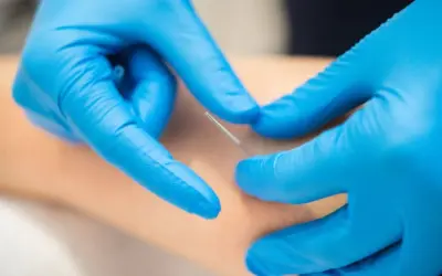 will dry needling help tennis elbow