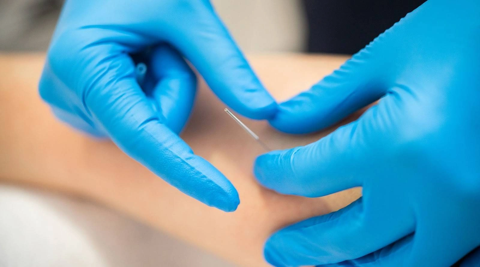 will dry needling help tennis elbow