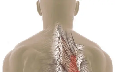dry needling vs trigger points