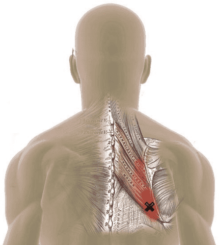 dry needling vs trigger points