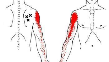 will dry needling help frozen shoulder