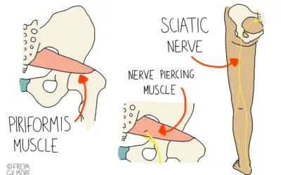 will dry needling help piriformis syndrome