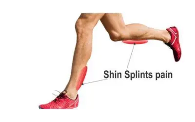 will dry needling help shin splints