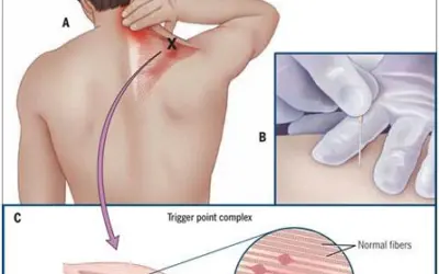will dry needling help sciatica