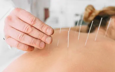 what does dry needling help