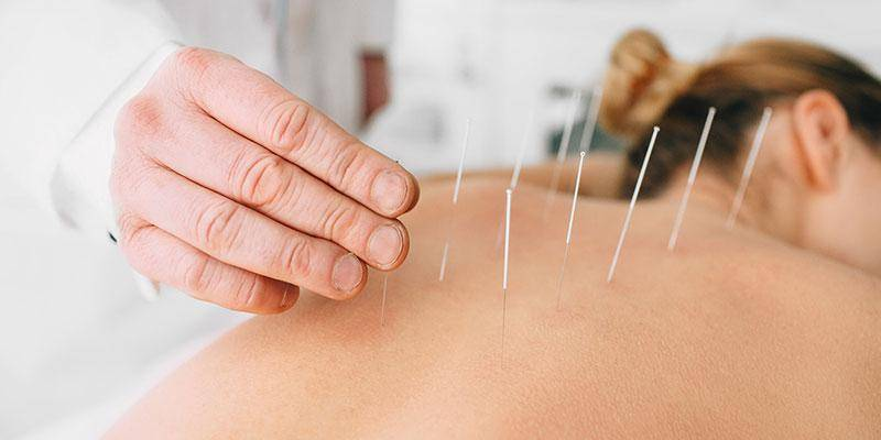 download-2025-12-03T191812.087 what does dry needling help