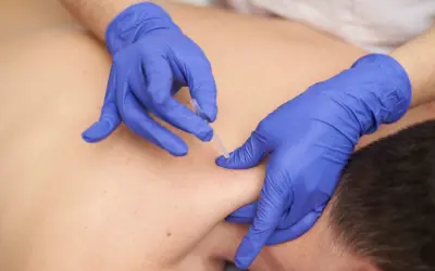 what does dry needling feel like