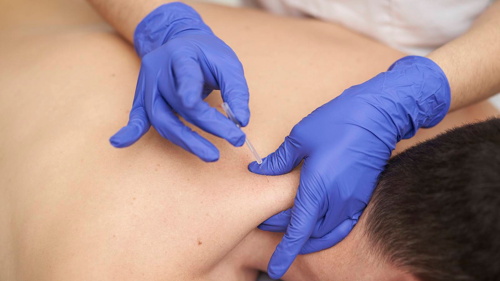 what does dry needling feel like