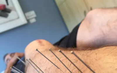 what is dry needling in physical therapy