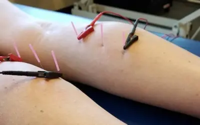 what is dry needling good for