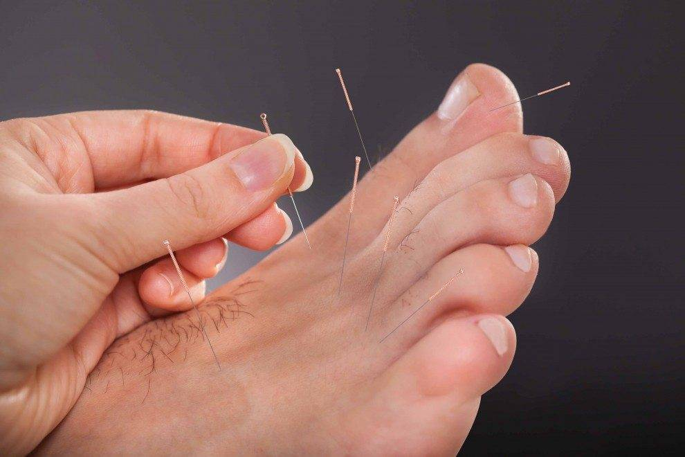 download-2025-12-03T192230.644 how does dry needling help plantar fasciitis