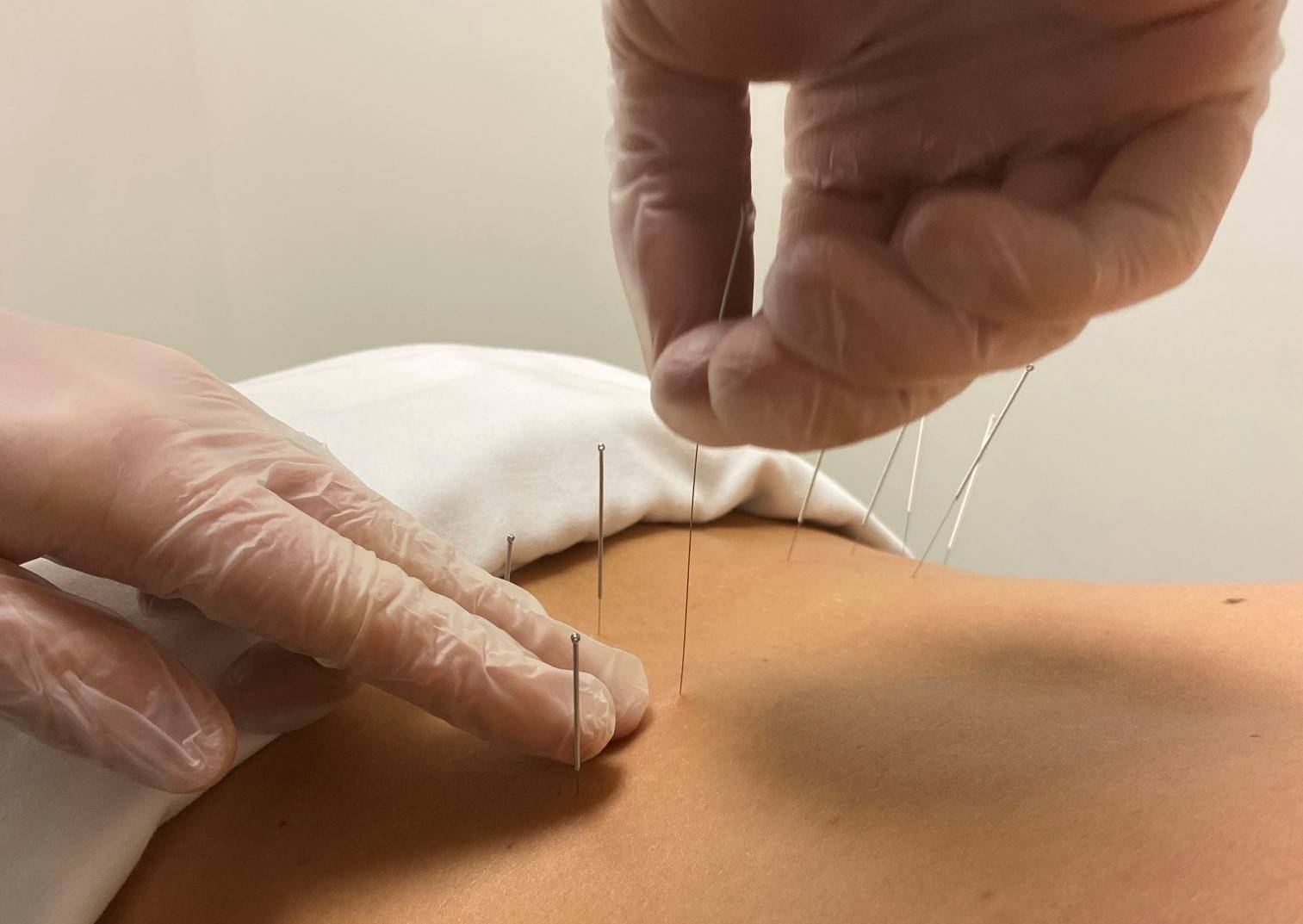 download-2025-12-03T192251.359 what dry needling does