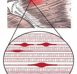 how does dry needling release trigger points