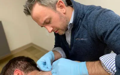 how often dry needling