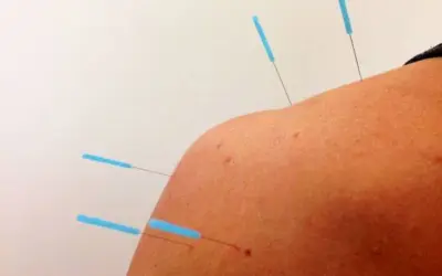 how is dry needling different from acupuncture