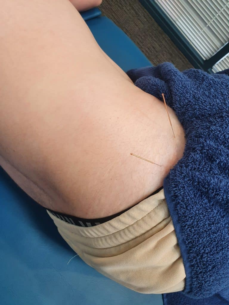 download-2025-12-03T192603.734 can dry needling help sciatica