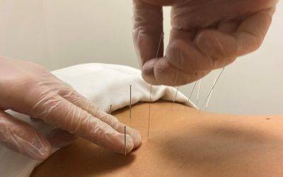 what dry needling does