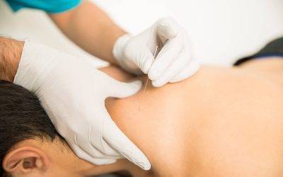 can dry needling cause nerve damage